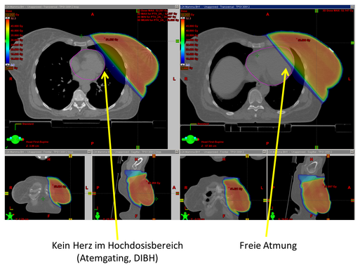 Atemkontrollierte Bestrahlung