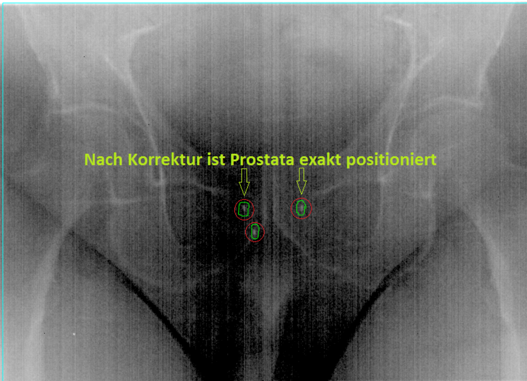 Prostata Nach Korrektur