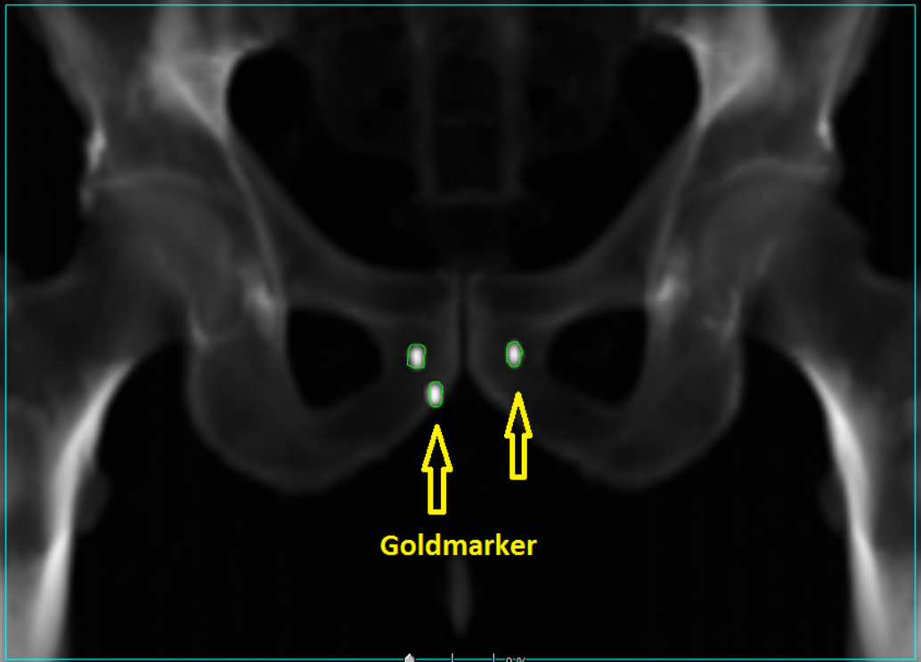 Prostata Goldmarker